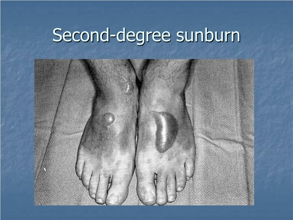 treating second degree sunburn treating second degree sunburn