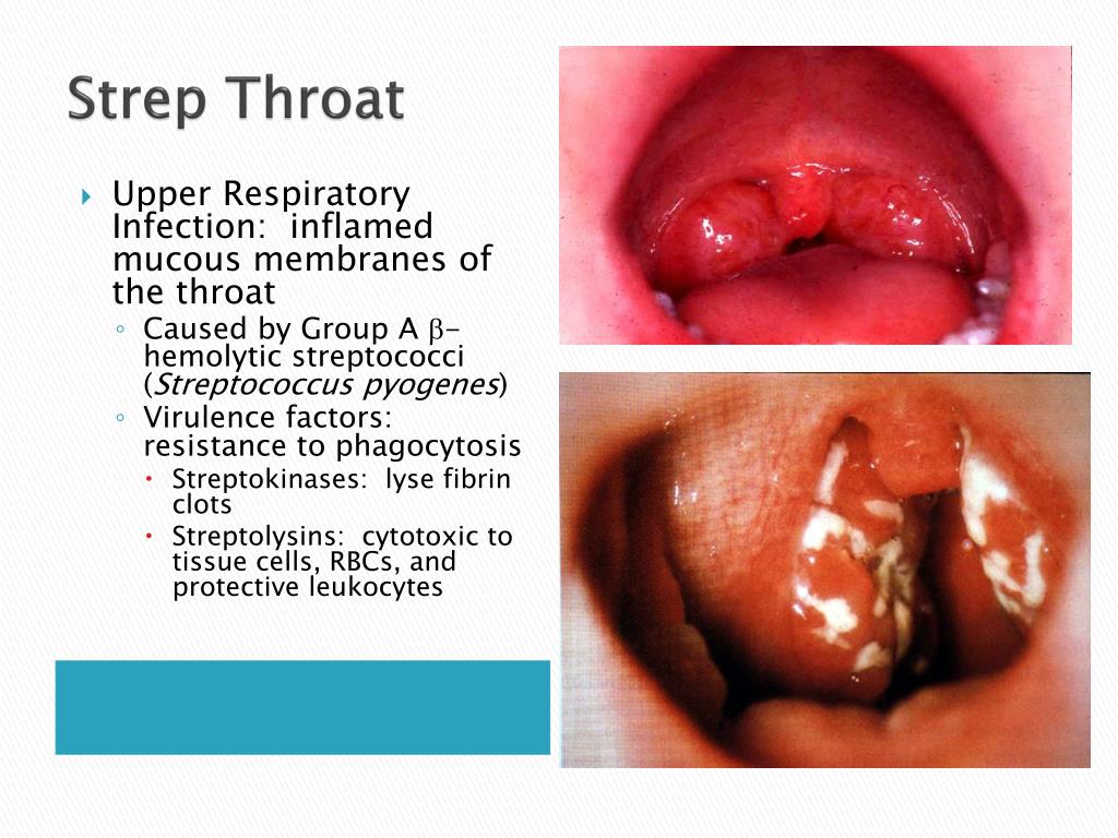 inflamed mucous membranes of the throat * Caused by Group A ?-hemolytic str...
