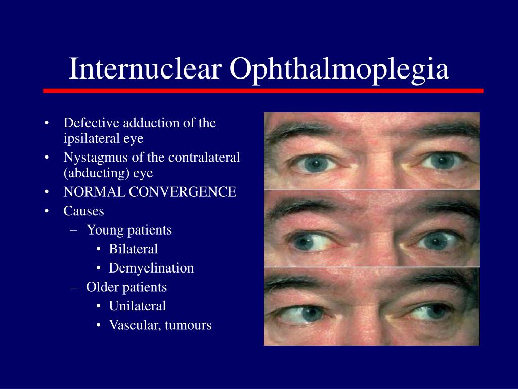 PPT - NEURO-OPHTHALMOLOGY PowerPoint Presentation, free download - ID ...