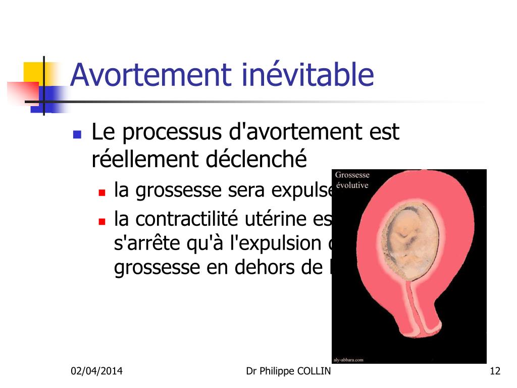 avortement par 14