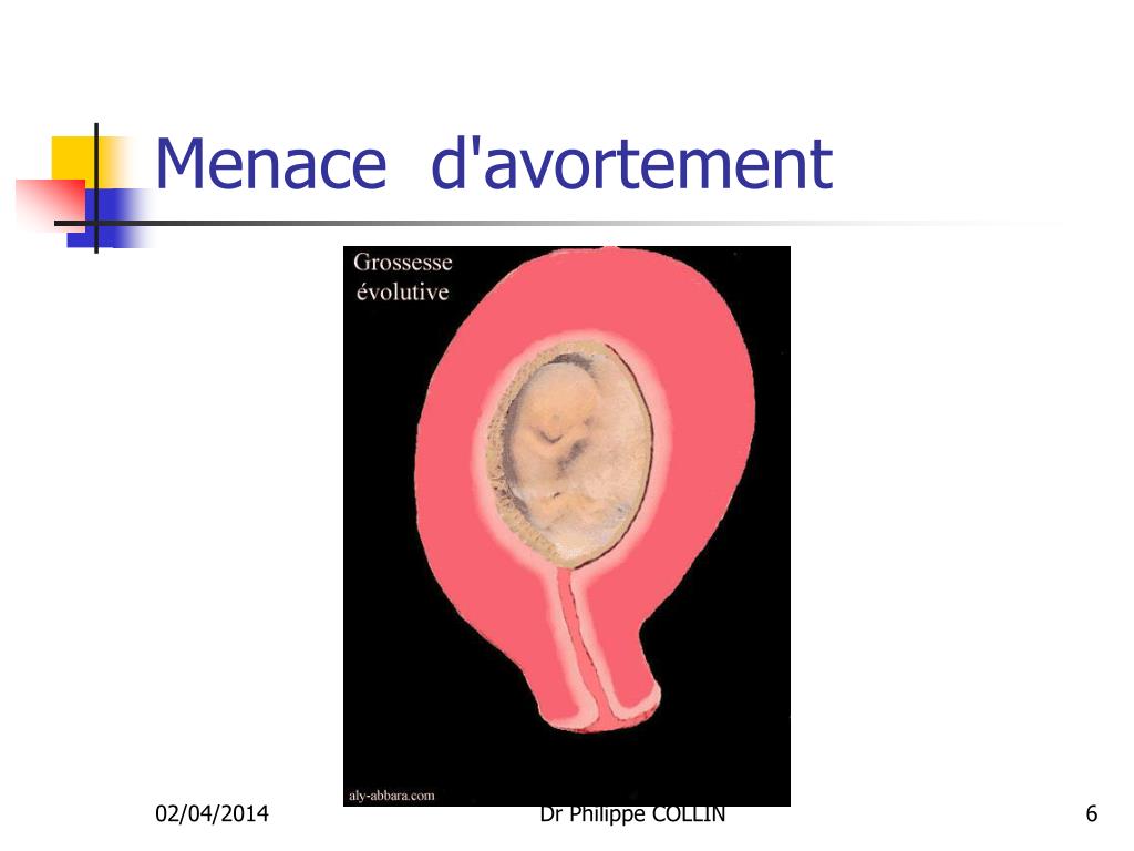 PPT Avortement Spontané PowerPoint Presentation ID720739.