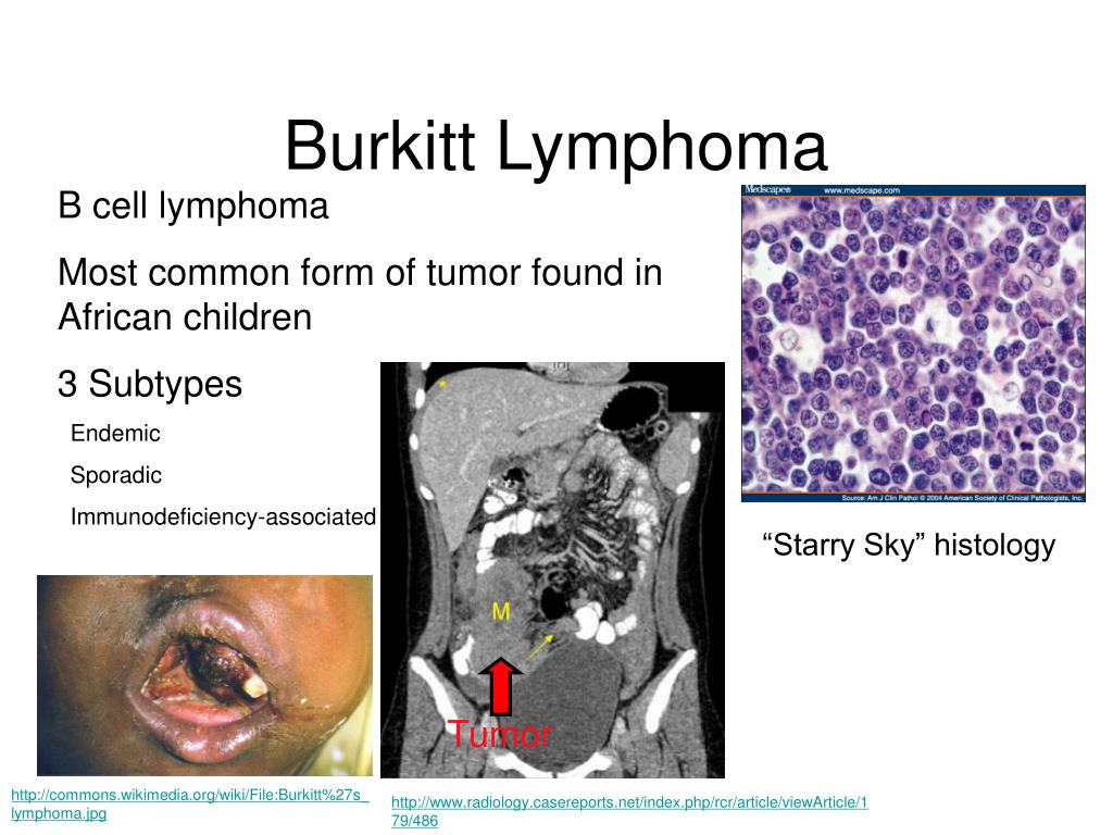 clinical presentation of burkitt's lymphoma