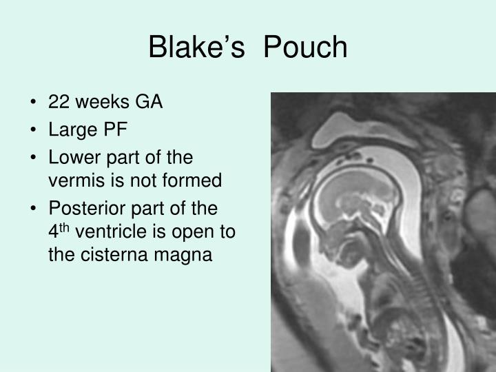 PPT - Anomalies of the Posterior Fossa and the Spinal Cord- Fetal MRI ...