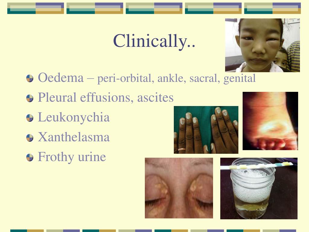 PPT Proteinuria in the Diagnosis & Management of Kidney Disease