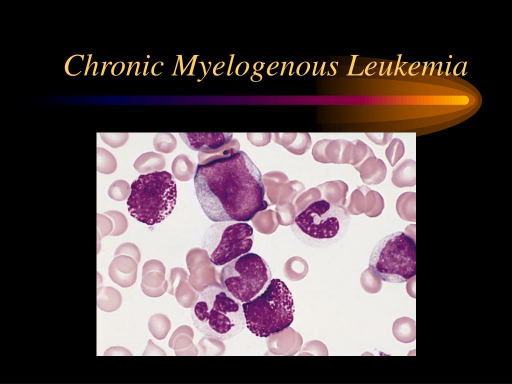Ppt White Blood Cell Disorders Powerpoint Presentation Free Download