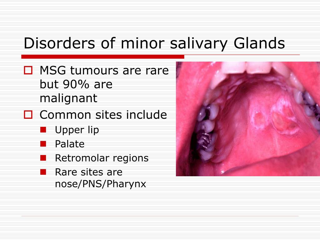 Ppt Salivary Glands Disorders Powerpoint Presentation Id734033