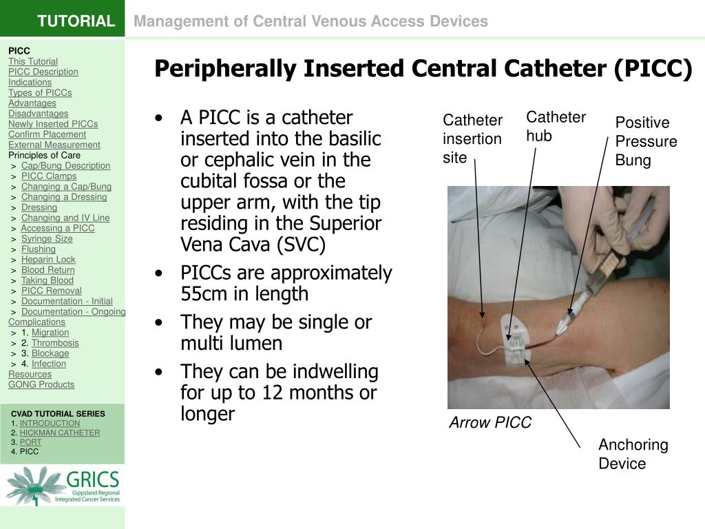 Central Venous Catheter Placement Procedure