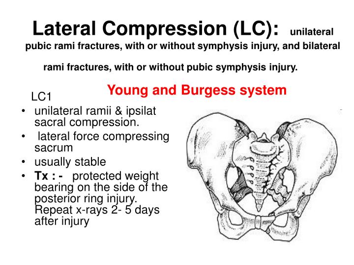 PPT Pelvis fracture PowerPoint Presentation ID737949