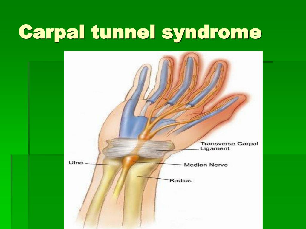 Carpal tunnel syndrome.