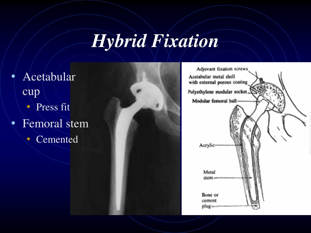 Ppt Hip Arthroplasty Powerpoint Presentation Free Download Id745056