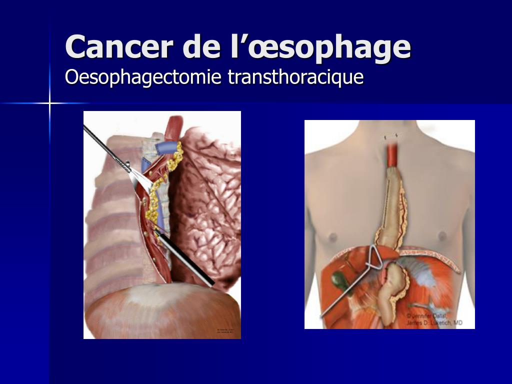 PPT - Comment je fais une oesophagectomie PowerPoint Presentation, free ...