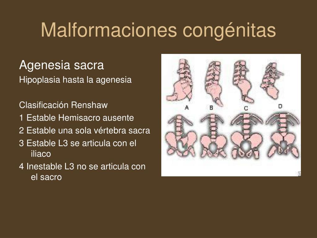 agenesia de la columna agenesia de la columna