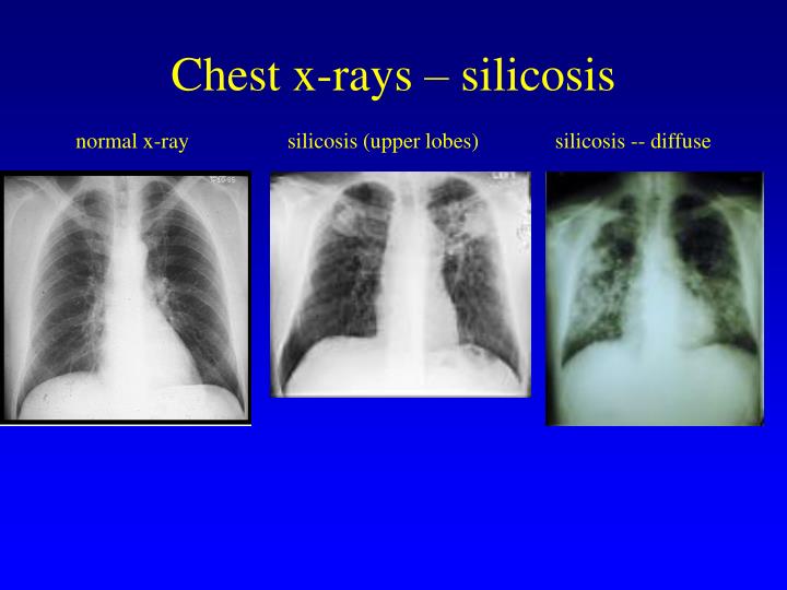 Ppt Silicosis Medical Aspects Powerpoint Presentation Free Download Id 759356