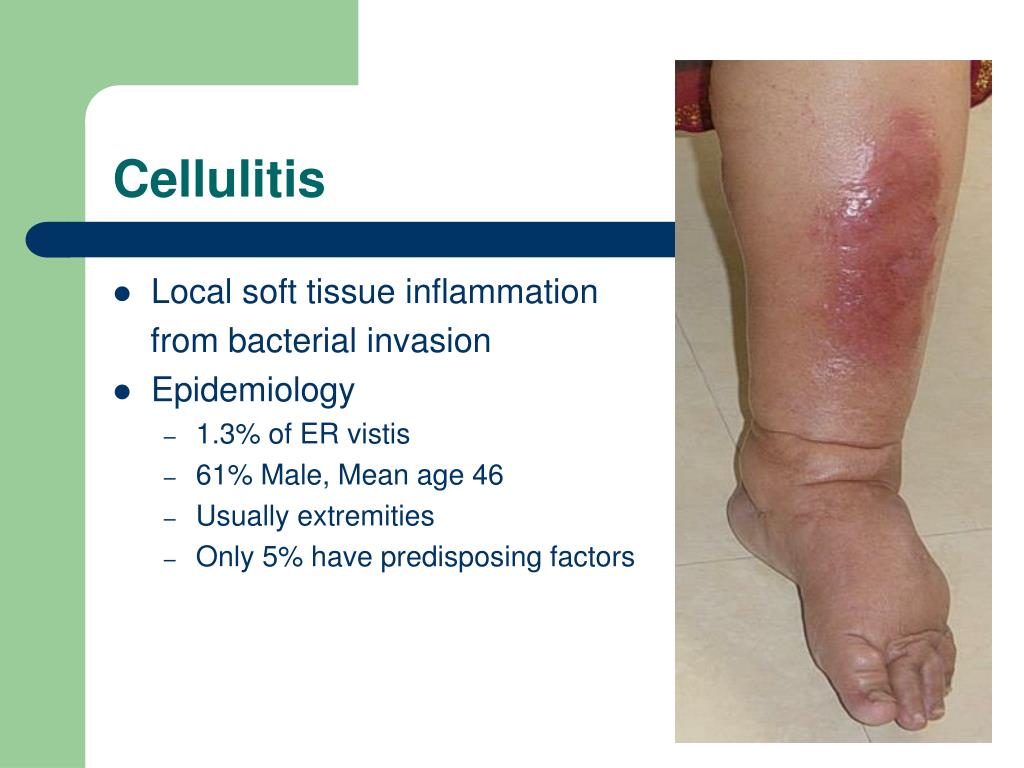 Ppt Soft Tissue Infections Powerpoint Presentation Free Download