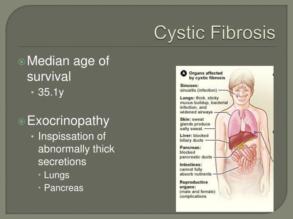 PPT - Cystic Fibrosis PowerPoint Presentation, free download