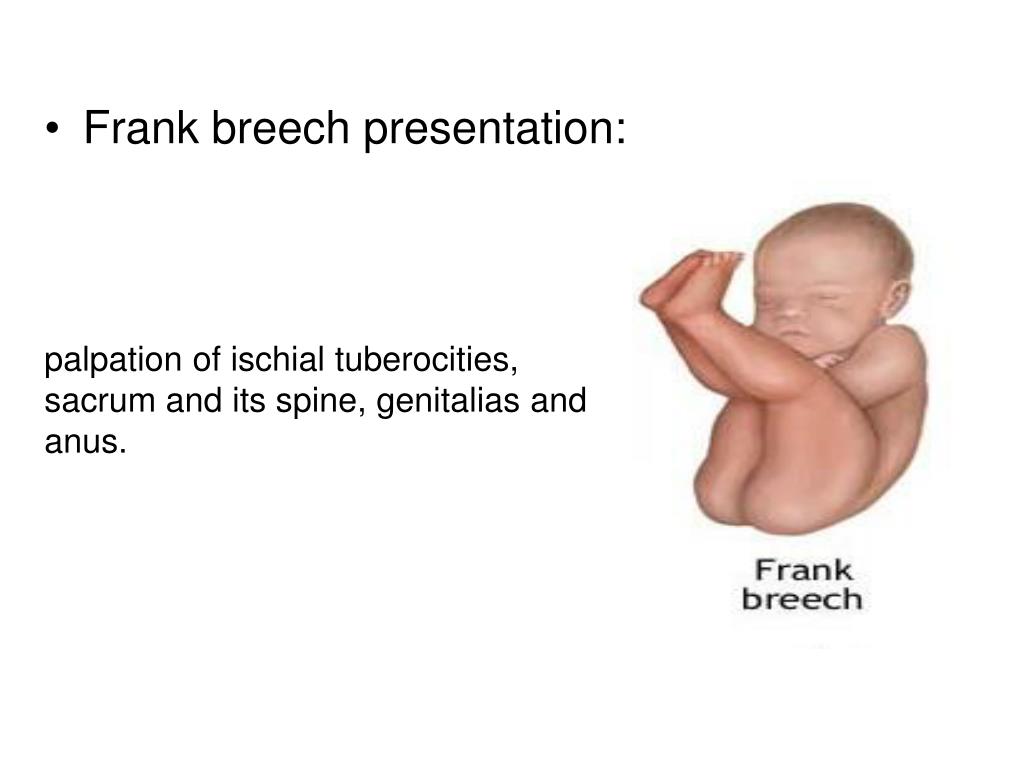 frank breech presentation definition