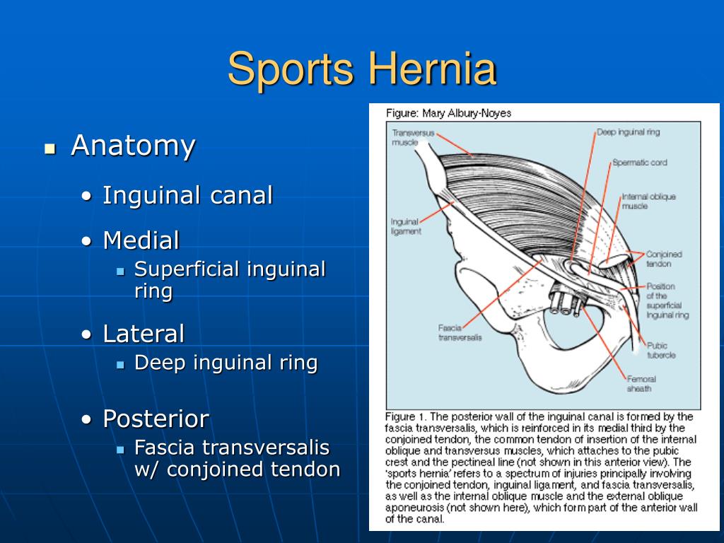 Sports Hernia7 L 