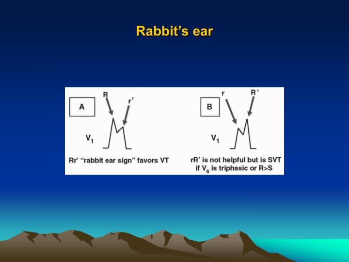 PPT APPROACH TO WIDE QRS COMPLEX TACHYCARDIA PowerPoint Presentation
