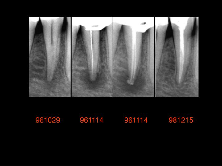 akutt apikal periodontitt akutt apikal periodontitt