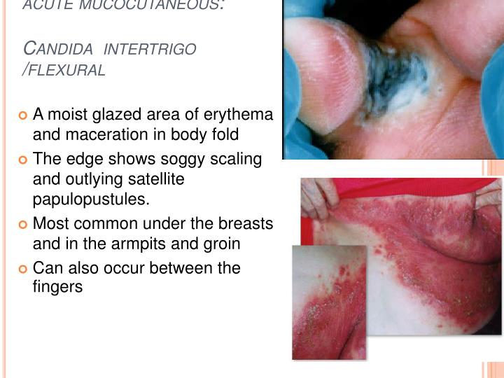 PPT Fungal infections Dermatophytic infections (ringworm) PowerPoint