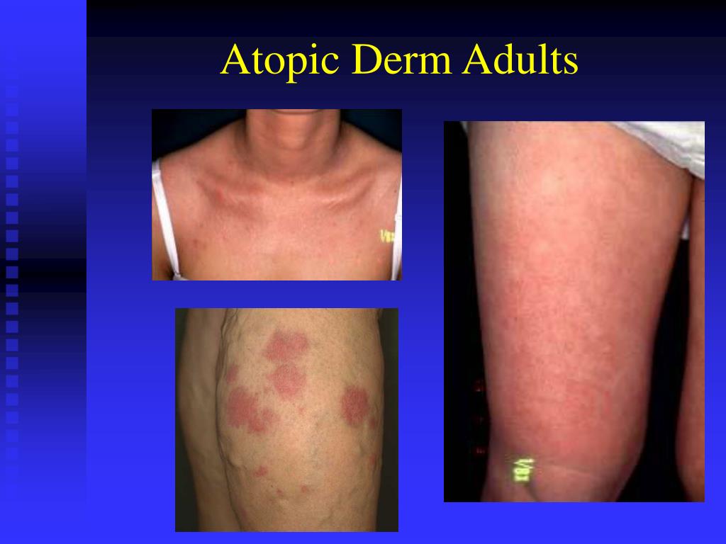 Ppt Atopic Dermatitis Powerpoint Presentation Free Download Id782987