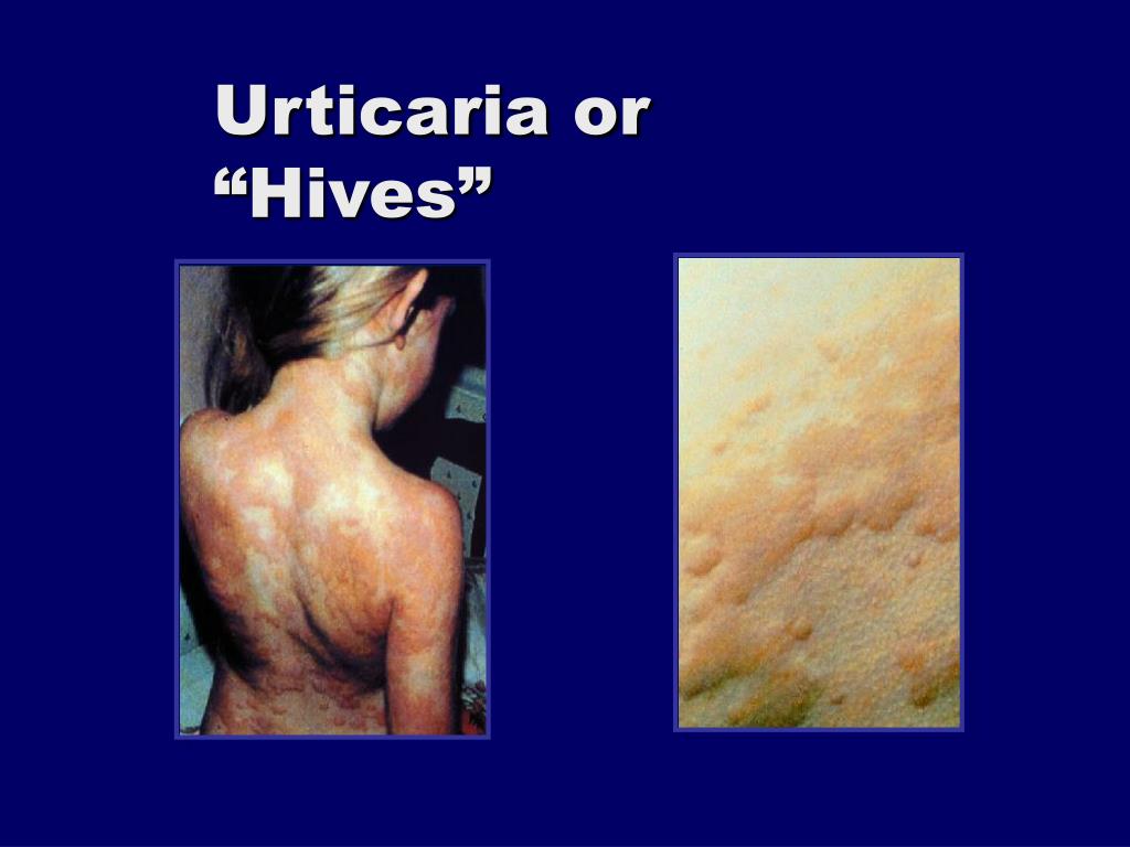 Ppt Urticaria And Angioedema 101 Powerpoint Presentation Free