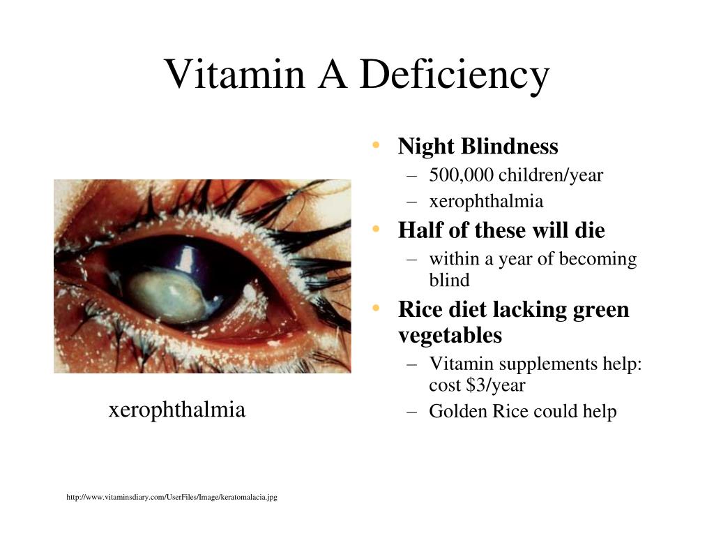 Vitamin deficiency. Ксерофтальмия дефицит. Презентация ксерофтальмия.