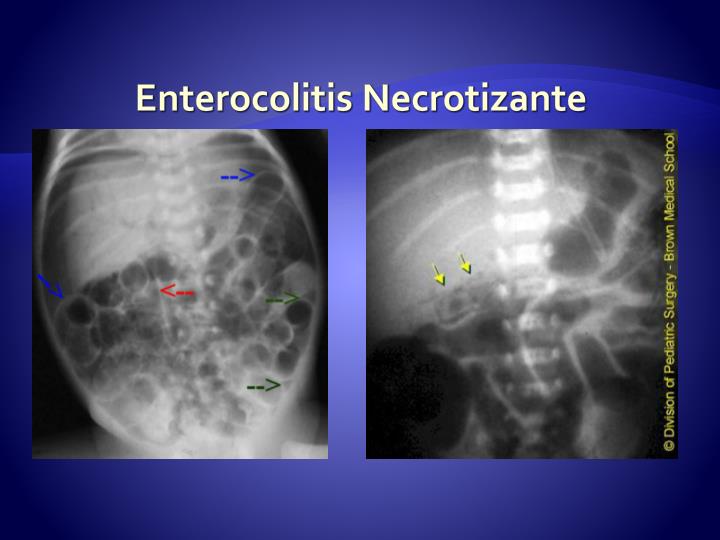 PPT - Enterocolitis Necrotizante ECN PowerPoint Presentation - ID:793344