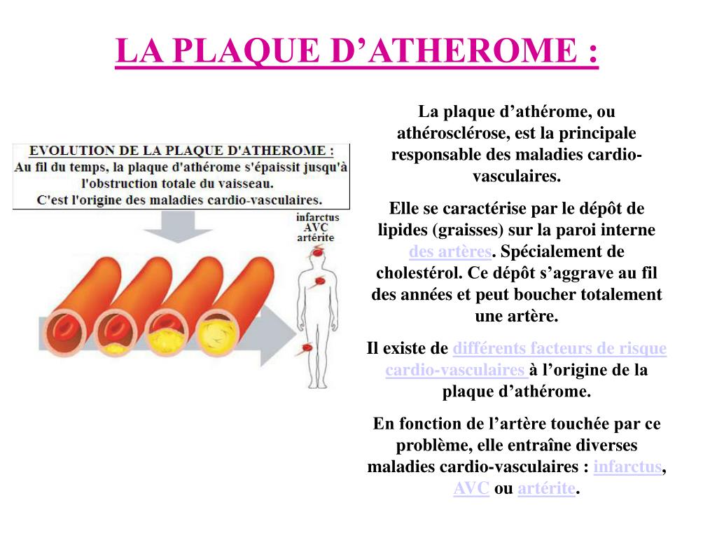 Comment Faire Disparaitre Les Plaques D Athérome