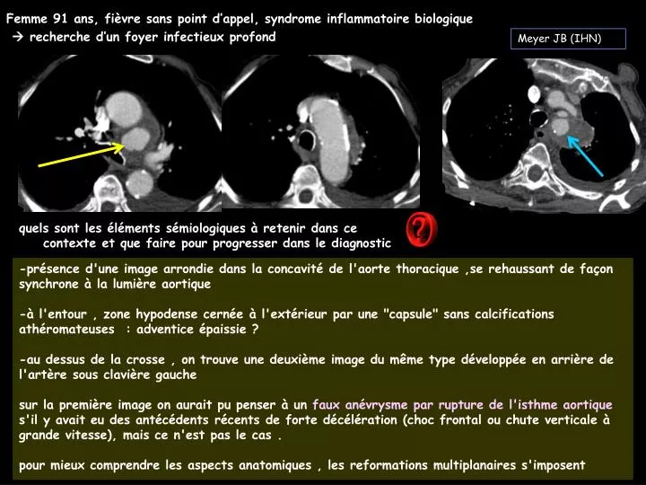 Profil Compatible Avec Un Syndrome Inflammatoire Modéré