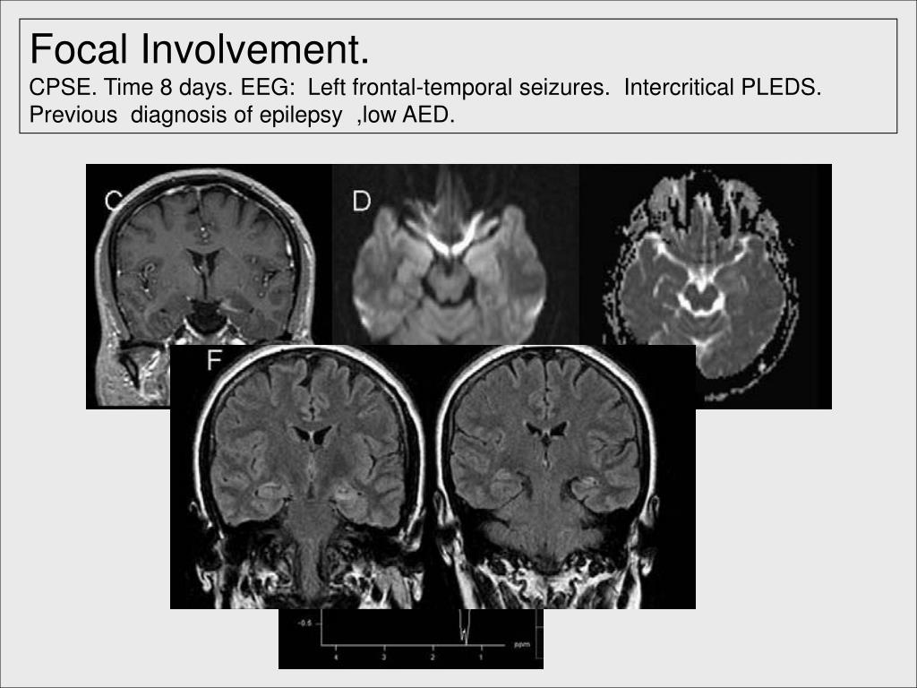 PPT - MRI Changes In Status Epilepticus: A Systematic Review In A ...