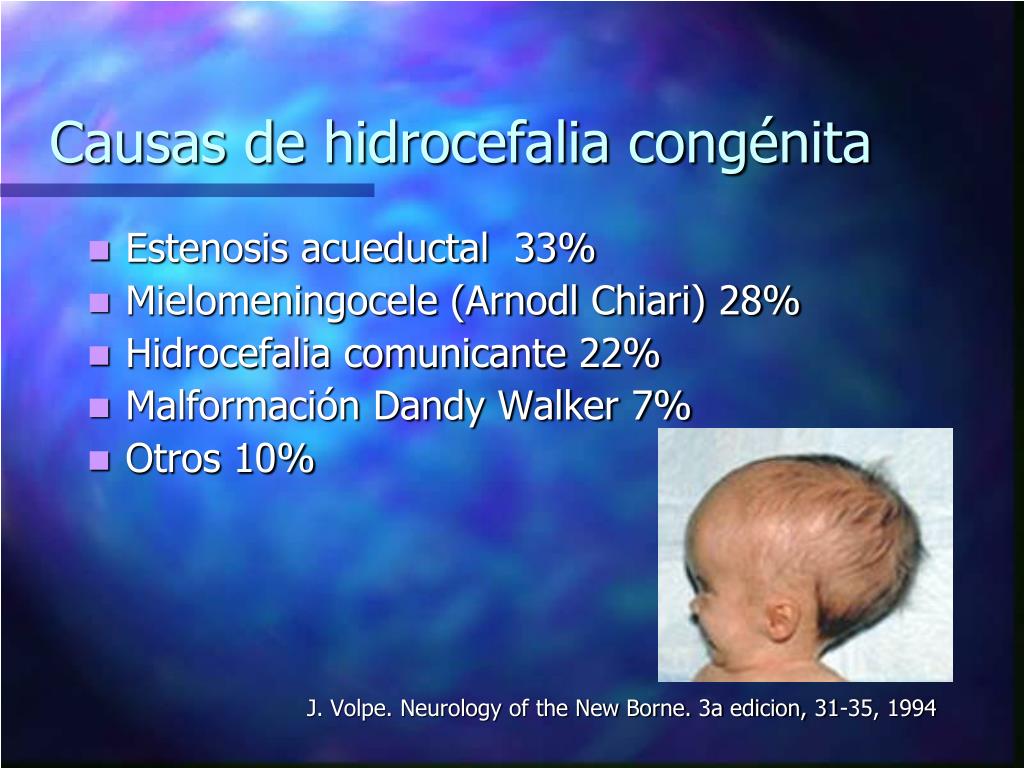 PPT - HIDROCEFALIA CONGENITA PowerPoint Presentation - ID