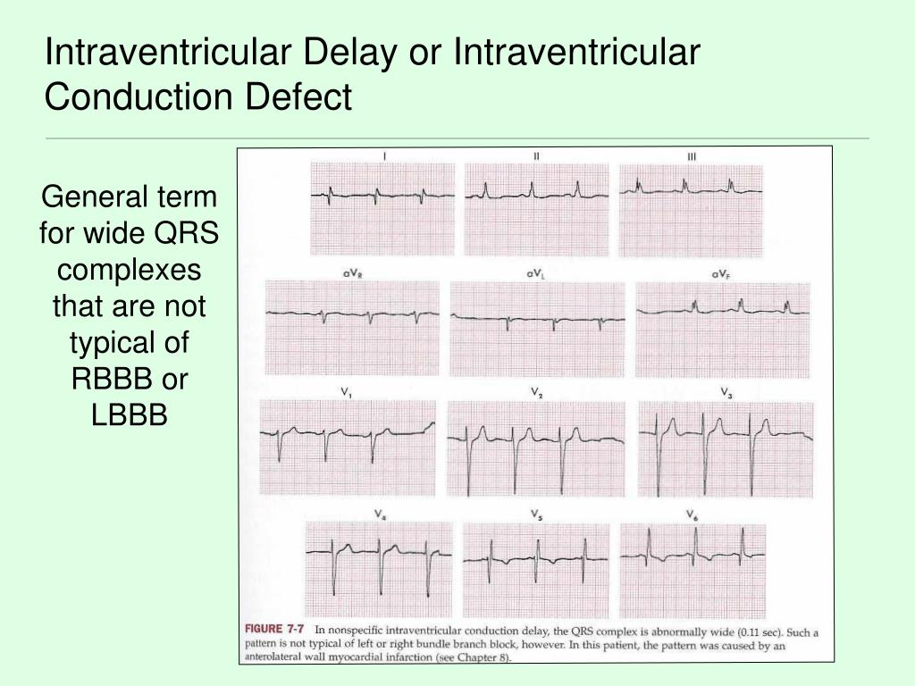 Ppt ventricular conduction disturbances powerpoint presentation free