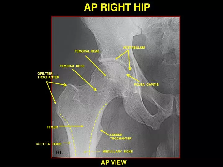 Ppt - Ap Right Hip Powerpoint Presentation, Free Download - Id:813234