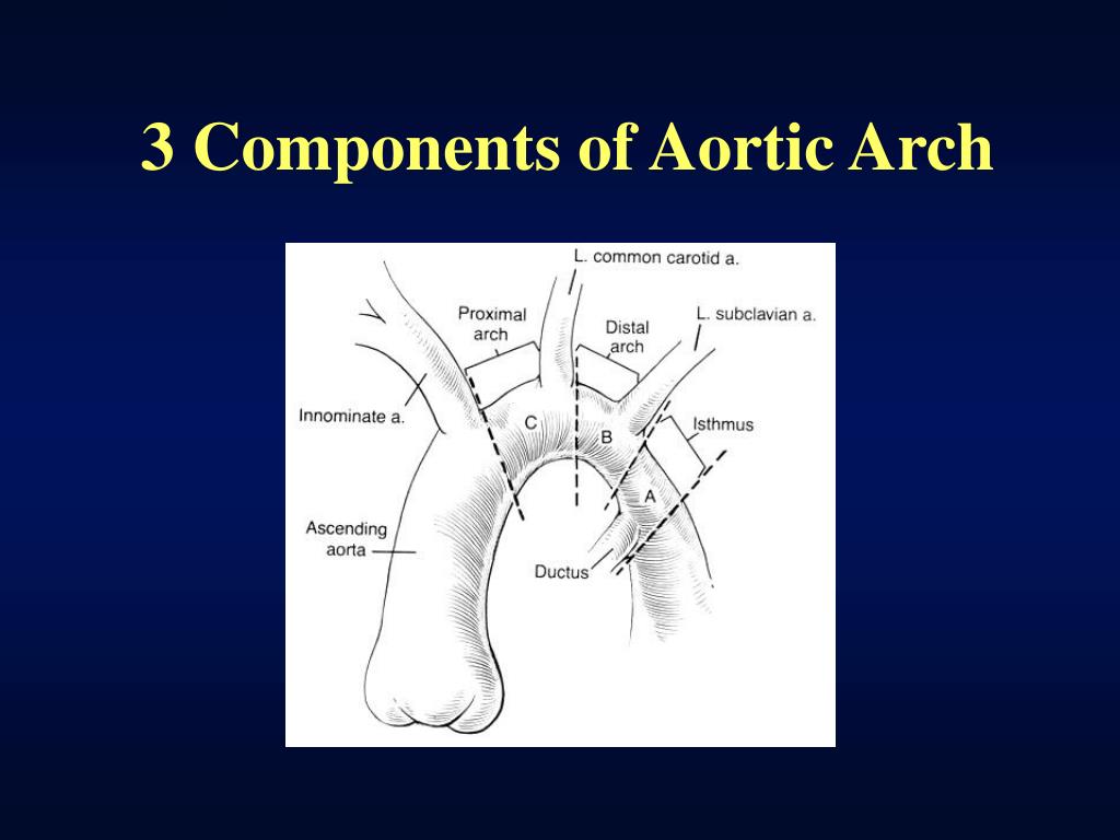interrupted aortic arch interrupted aortic arch