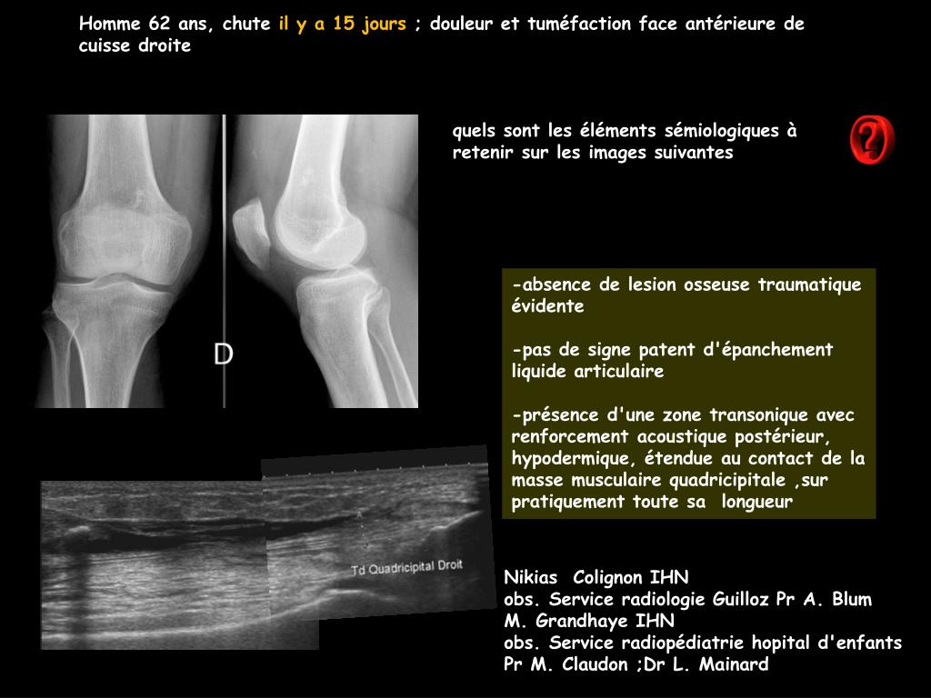 PPT Homme 62 ans chute il y a 15 jours douleur et tum faction