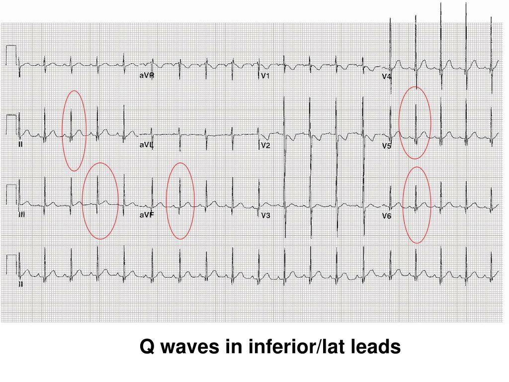 PPT Pediatric ECG s PowerPoint Presentation Free Download ID 828678 PPT Pediatric ECG s PowerPoint Presentation Free Download ID 828678