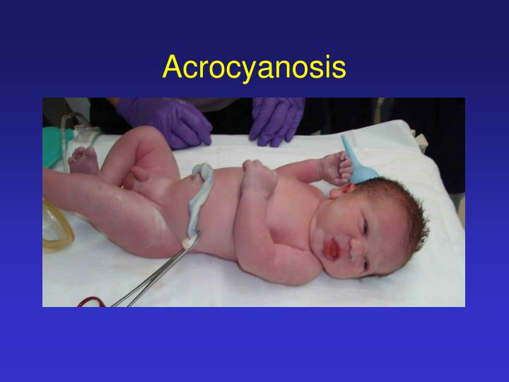 PPT - Cardiac Murmurs in the Newborn Infant PowerPoint ...
