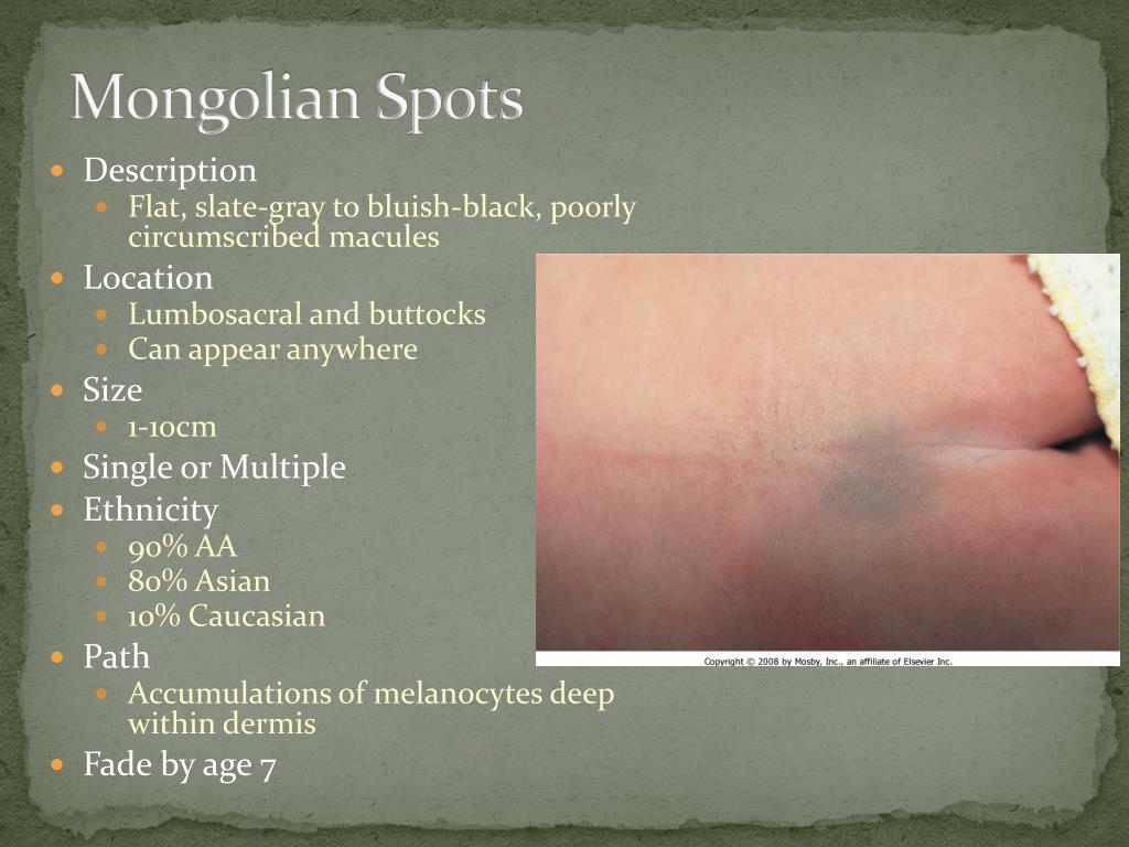 Mongolian Blue Spots Causes Mongolian Blue Spots CSKOQ