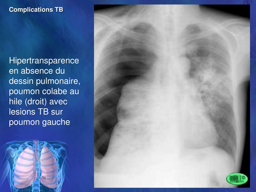 Lung rads 2. Очаги по lung rads. Lung rads классификация.