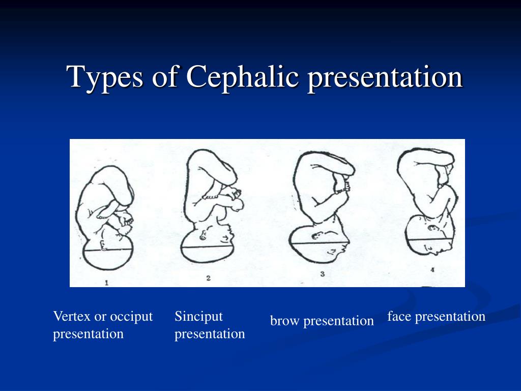definition of a cephalic presentation