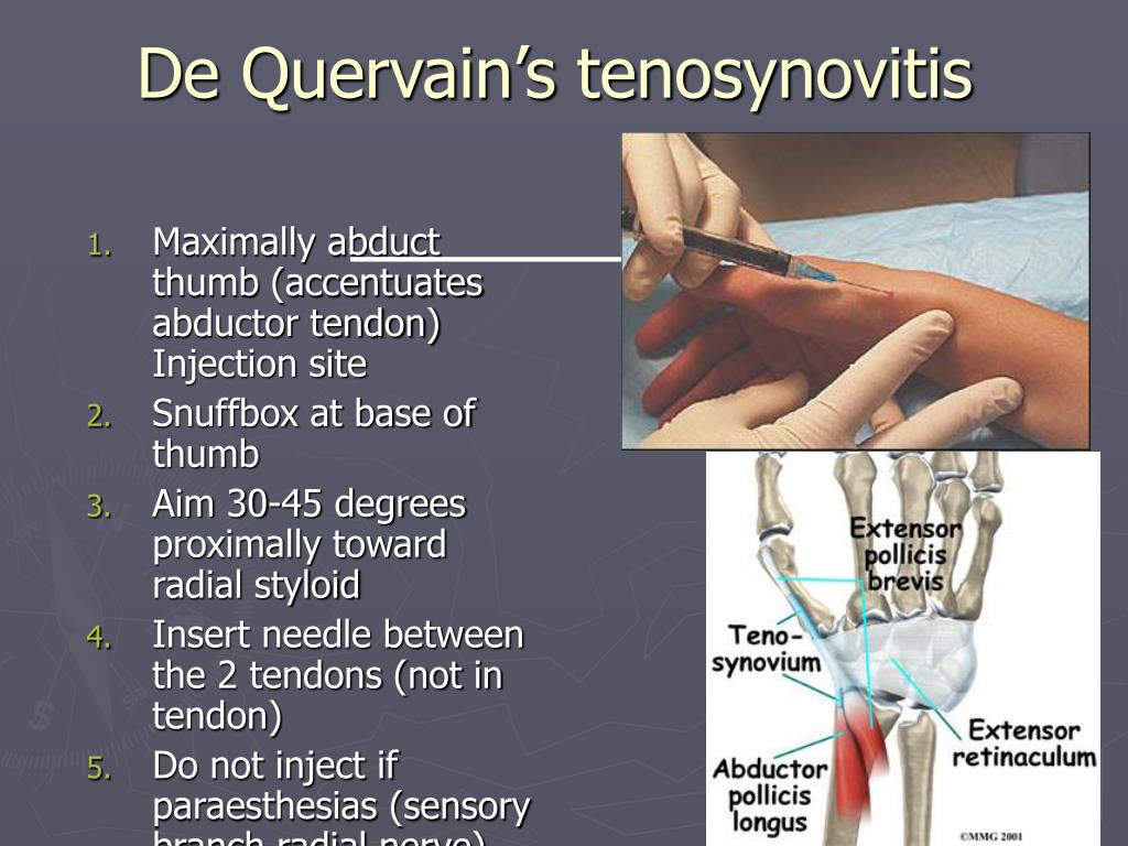 tendonitis steroid injection