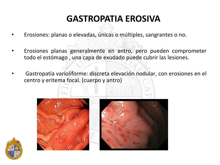 PPT - GASTROPATIAS DIFUSAS PowerPoint Presentation - ID:855249
