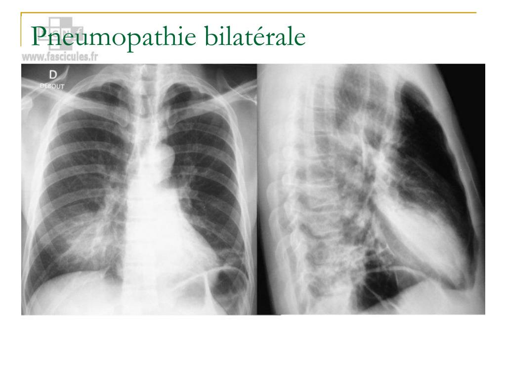 Pneumopathie D'inhalation Combien De Temps Apres Fausse Route PPT - PNEUMOPATHIE PowerPoint Presentation, free download - ID:855784
