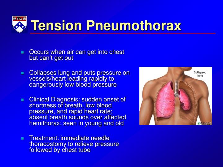 Tension Pneumothorax Pathophysiology