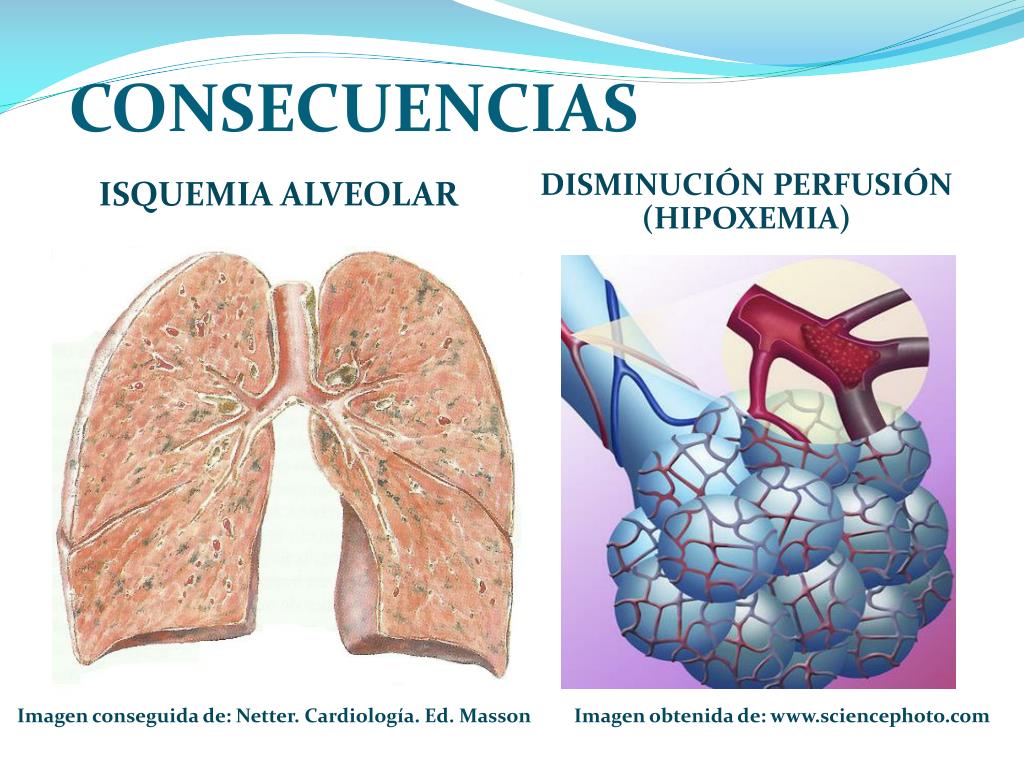 PPT - Esclerosis Vascular Embolia Pulmonar Hipertensión ...