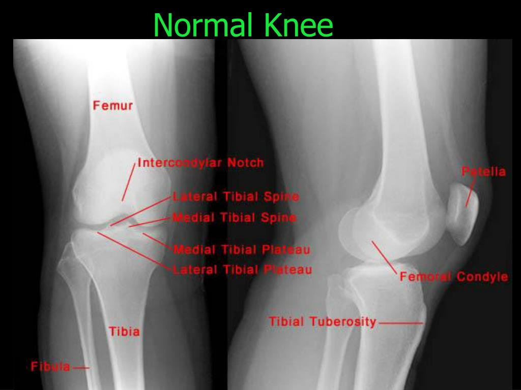 Normal Knee.