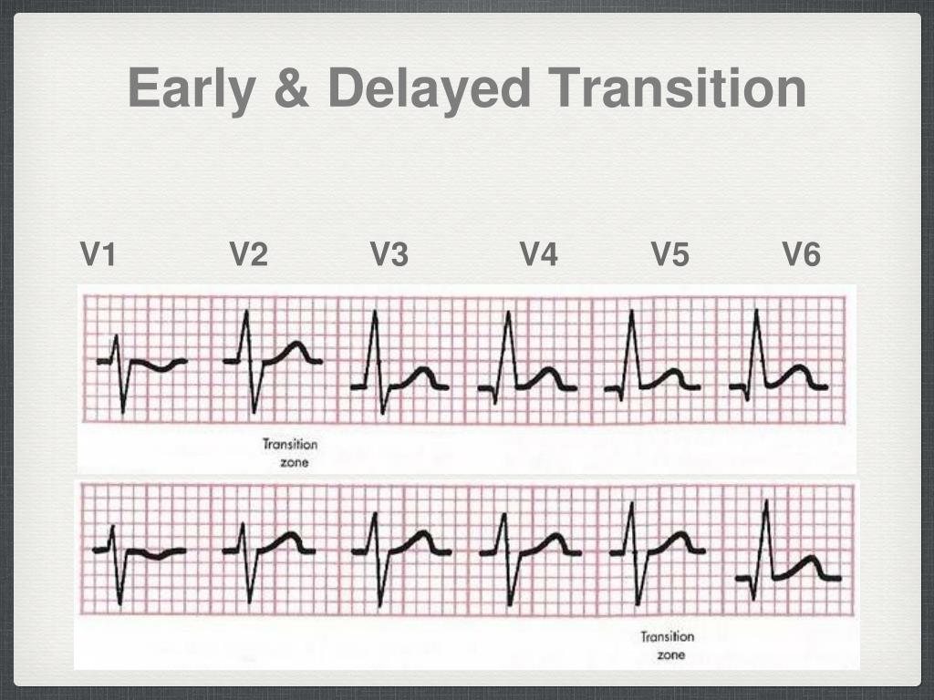 V1 V2 V3 V4 V5 V6 Ecg - SOLOLEARN