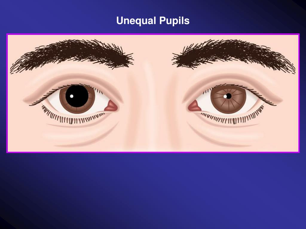 unequal pupil size in newborn unequal pupil size in newborn