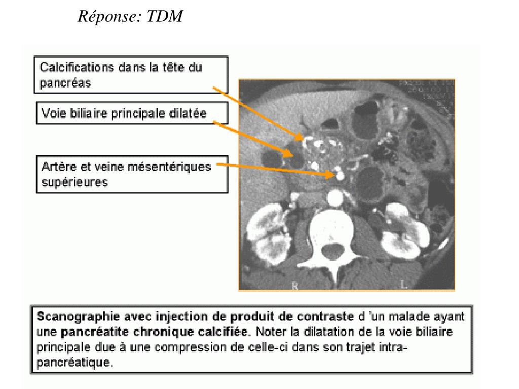 PPT - Cas clinique pancréatite chronique PowerPoint Presentation, free ...